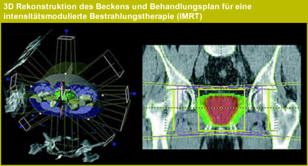 3D Rekonstruktion des Beckens