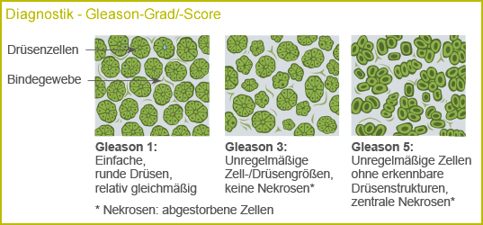 Diagnosik Gleason-Grad-Score 1