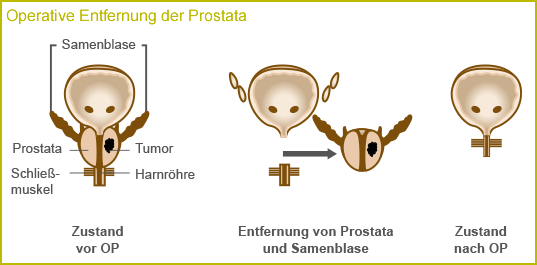Operative Entfernung der Prostata
