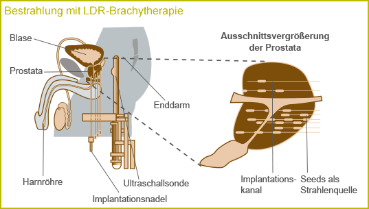 Bestrahlung mit LDR-Brachytherapie